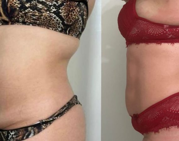 Antes e depois